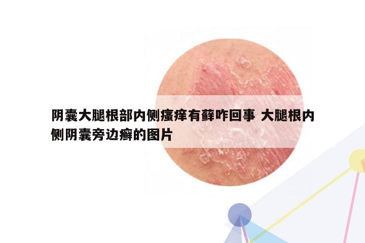 阴囊大腿根部内侧瘙痒有藓咋回事 大腿根内侧阴囊旁边癣的图片