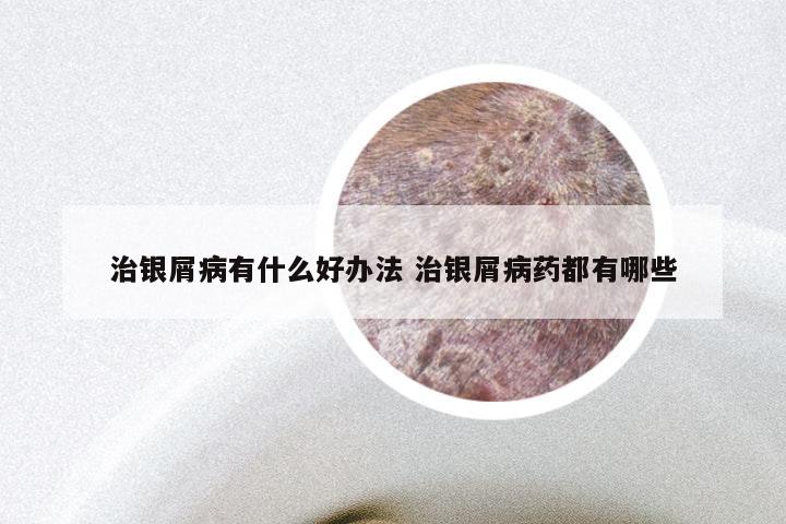 治银屑病有什么好办法 治银屑病药都有哪些