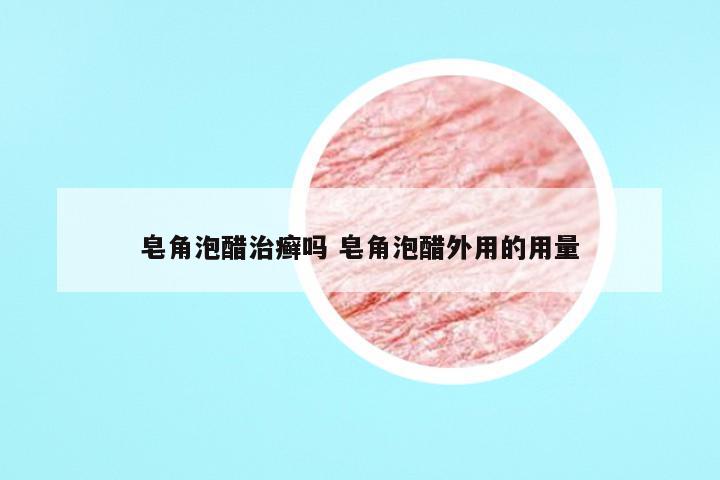 皂角泡醋治癣吗 皂角泡醋外用的用量