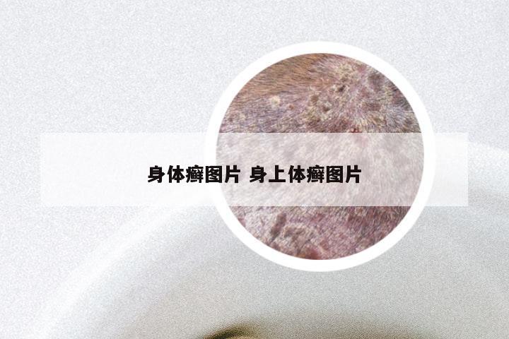 身体癣图片 身上体癣图片