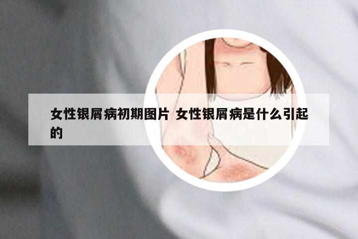 女性银屑病初期图片 女性银屑病是什么引起的