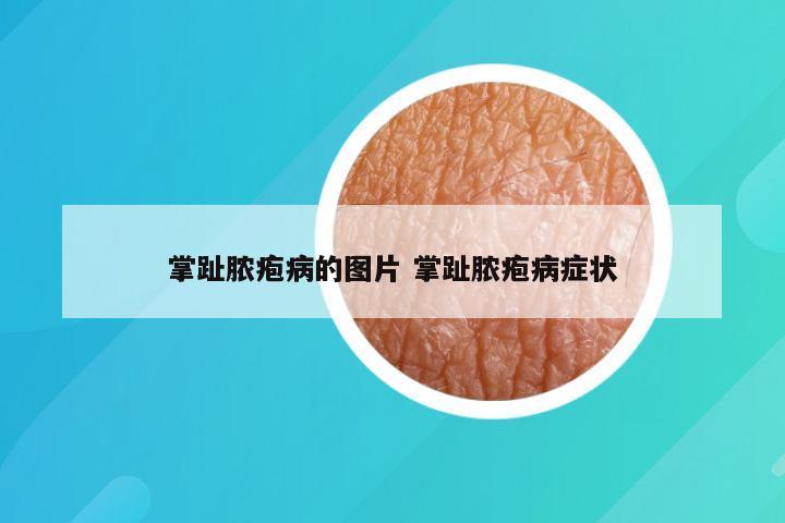 掌趾脓疱病的图片 掌趾脓疱病症状