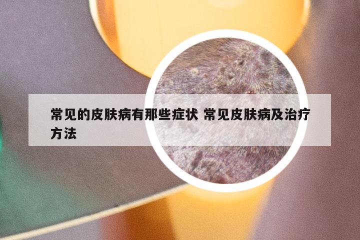 常见的皮肤病有那些症状 常见皮肤病及治疗方法