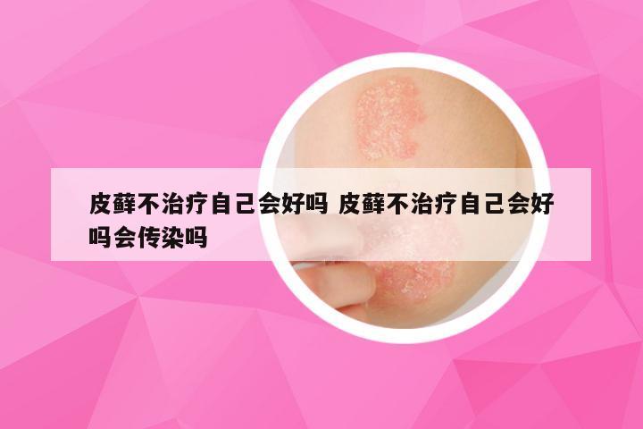 皮藓不治疗自己会好吗 皮藓不治疗自己会好吗会传染吗