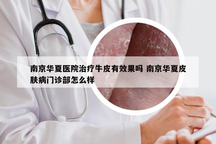 南京华夏医院治疗牛皮有效果吗 南京华夏皮肤病门诊部怎么样