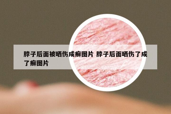 脖子后面被晒伤成癣图片 脖子后面晒伤了成了癣图片