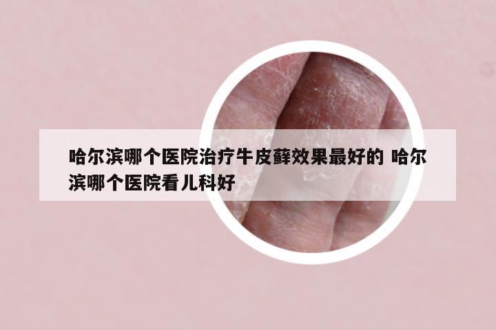 哈尔滨哪个医院治疗牛皮藓效果最好的 哈尔滨哪个医院看儿科好