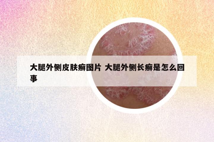 大腿外侧皮肤癣图片 大腿外侧长癣是怎么回事