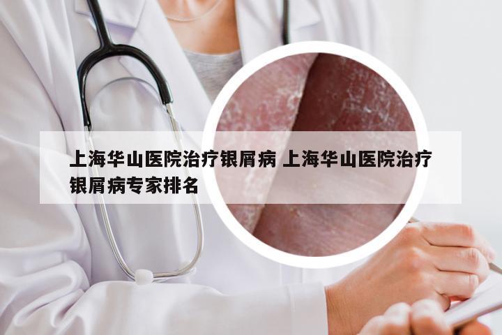 上海华山医院治疗银屑病 上海华山医院治疗银屑病专家排名