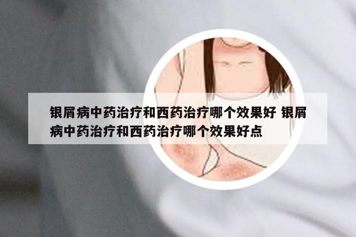 银屑病中药治疗和西药治疗哪个效果好 银屑病中药治疗和西药治疗哪个效果好点