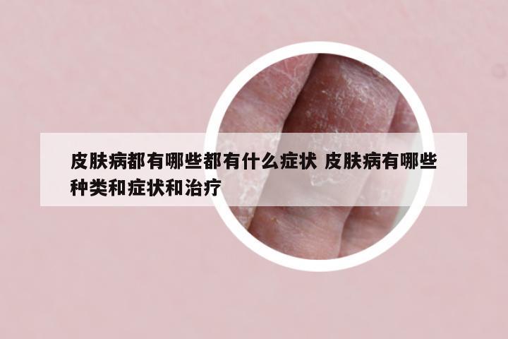 皮肤病都有哪些都有什么症状 皮肤病有哪些种类和症状和治疗