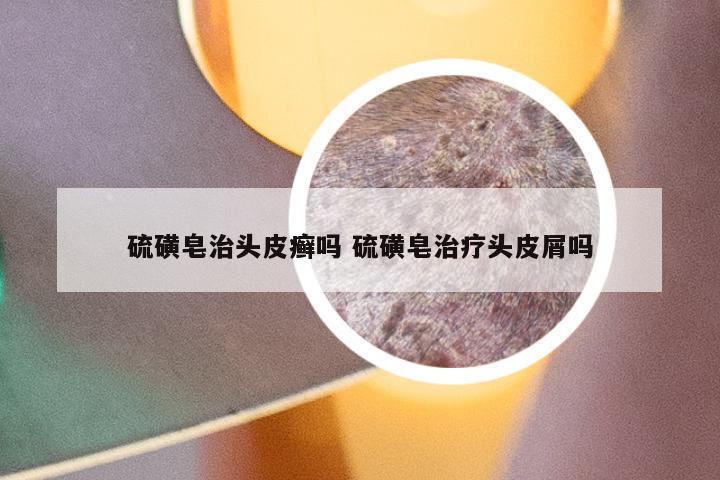 硫磺皂治头皮癣吗 硫磺皂治疗头皮屑吗