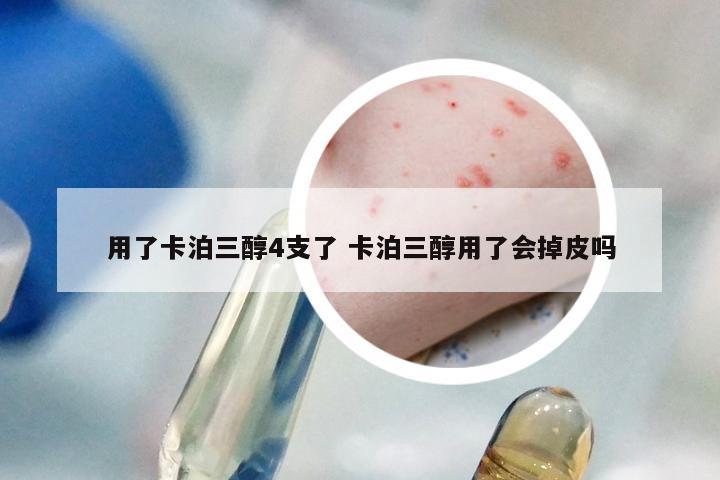 用了卡泊三醇4支了 卡泊三醇用了会掉皮吗