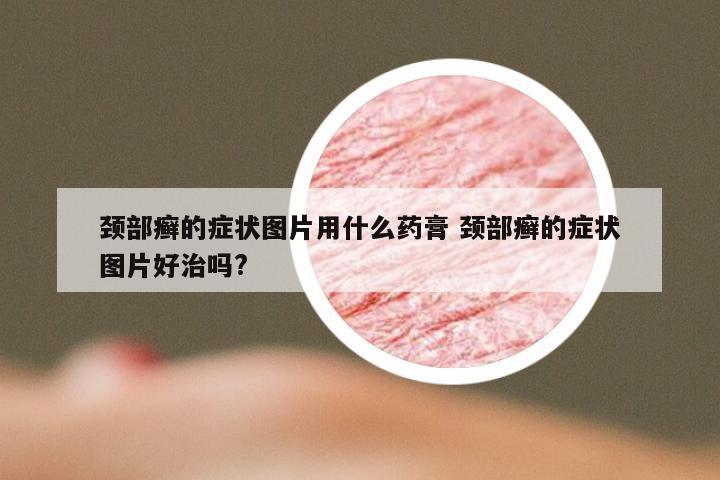 颈部癣的症状图片用什么药膏 颈部癣的症状图片好治吗?