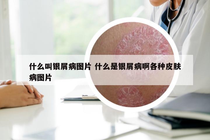 什么叫银屑病图片 什么是银屑病啊各种皮肤病图片