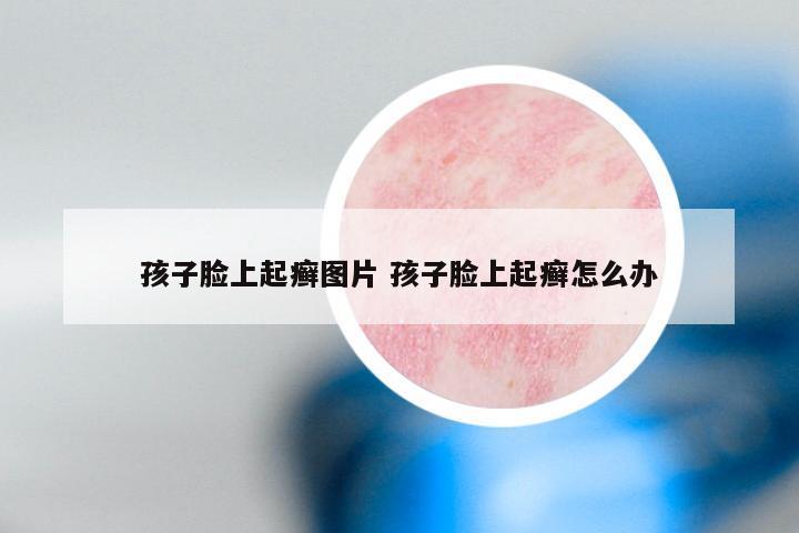 孩子脸上起癣图片 孩子脸上起癣怎么办