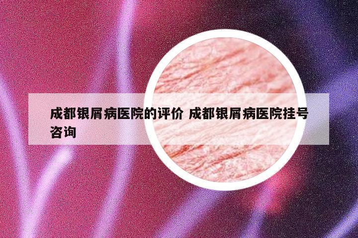 成都银屑病医院的评价 成都银屑病医院挂号咨询