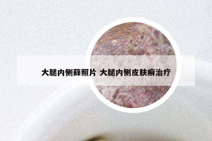 大腿内侧藓照片 大腿内侧皮肤癣治疗