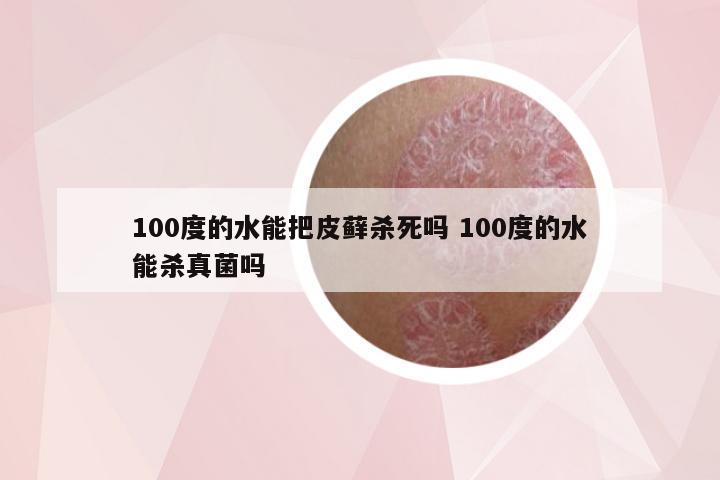 100度的水能把皮藓杀死吗 100度的水能杀真菌吗