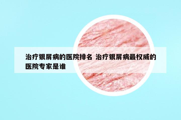 治疗银屑病的医院排名 治疗银屑病最权威的医院专家是谁