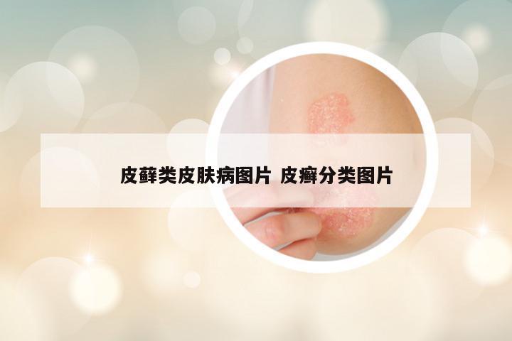 皮藓类皮肤病图片 皮癣分类图片