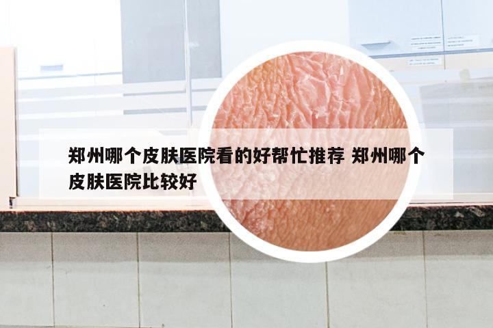 郑州哪个皮肤医院看的好帮忙推荐 郑州哪个皮肤医院比较好