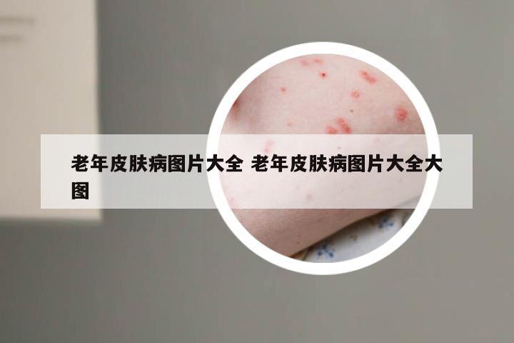 老年皮肤病图片大全 老年皮肤病图片大全大图
