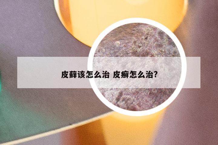 皮藓该怎么治 皮癣怎么治?