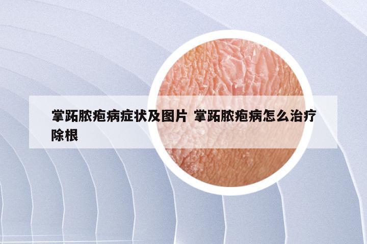 掌跖脓疱病症状及图片 掌跖脓疱病怎么治疗除根