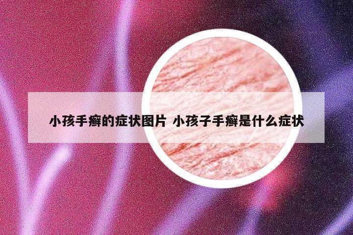 小孩手癣的症状图片 小孩子手癣是什么症状