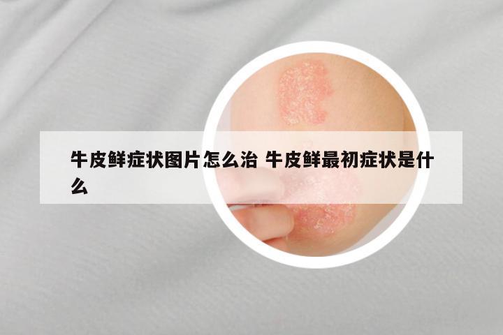 牛皮鲜症状图片怎么治 牛皮鲜最初症状是什么
