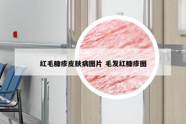 红毛糠疹皮肤病图片 毛发红糠疹图