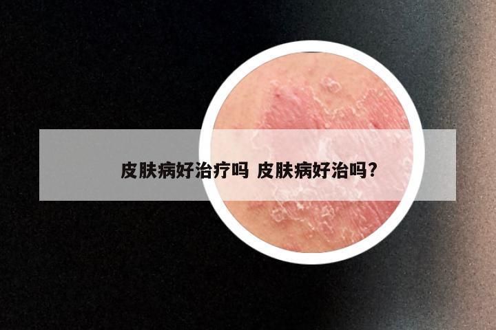 皮肤病好治疗吗 皮肤病好治吗?