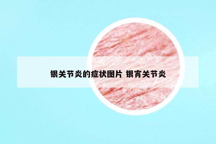 银关节炎的症状图片 银宵关节炎