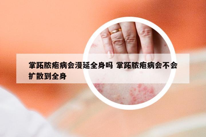 掌跖脓疱病会漫延全身吗 掌跖脓疱病会不会扩散到全身