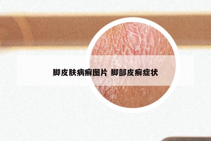 脚皮肤病癣图片 脚部皮癣症状