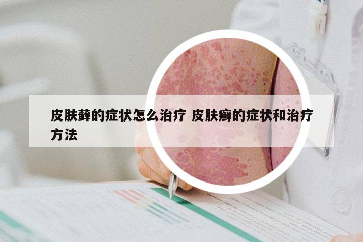 皮肤藓的症状怎么治疗 皮肤癣的症状和治疗方法
