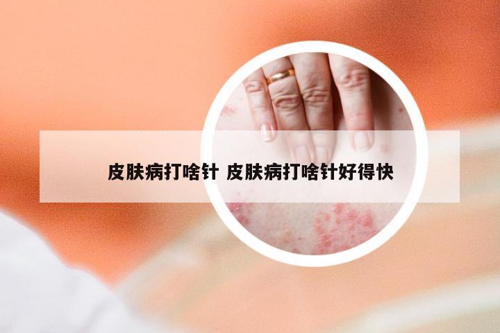 皮肤病打啥针 皮肤病打啥针好得快
