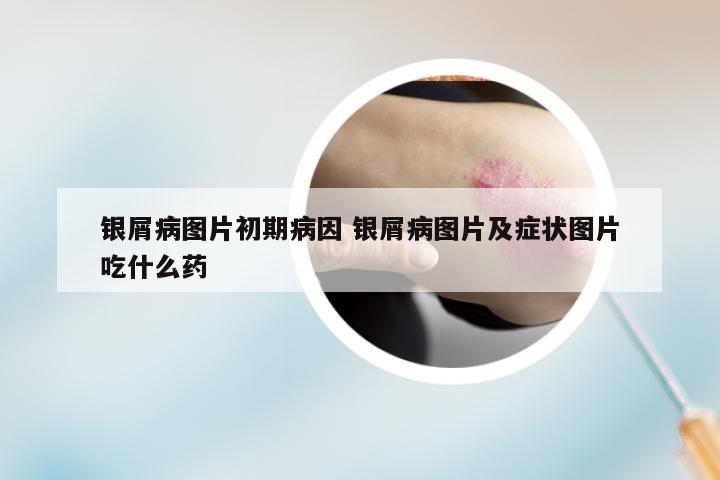 银屑病图片初期病因 银屑病图片及症状图片吃什么药