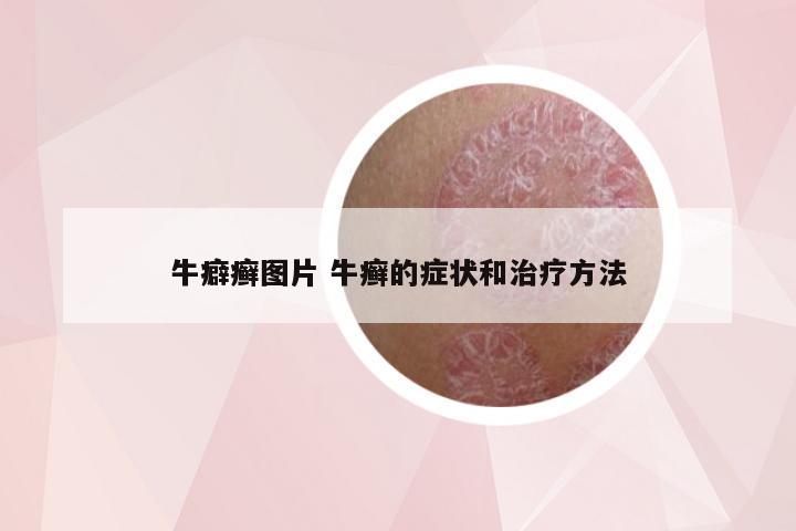 牛癖癣图片 牛癣的症状和治疗方法