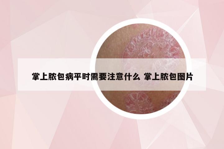 掌上脓包病平时需要注意什么 掌上脓包图片