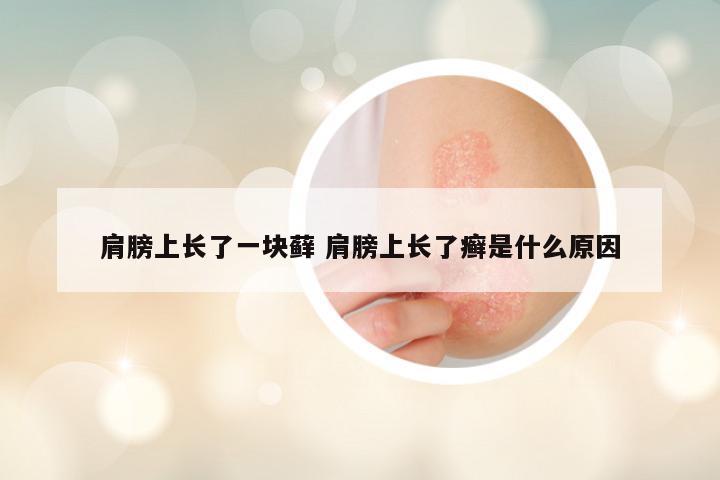 肩膀上长了一块藓 肩膀上长了癣是什么原因