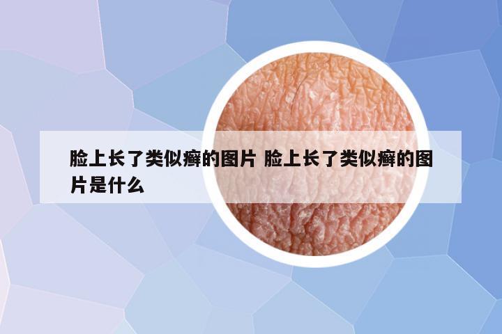 脸上长了类似癣的图片 脸上长了类似癣的图片是什么