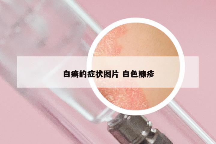 白癣的症状图片 白色糠疹
