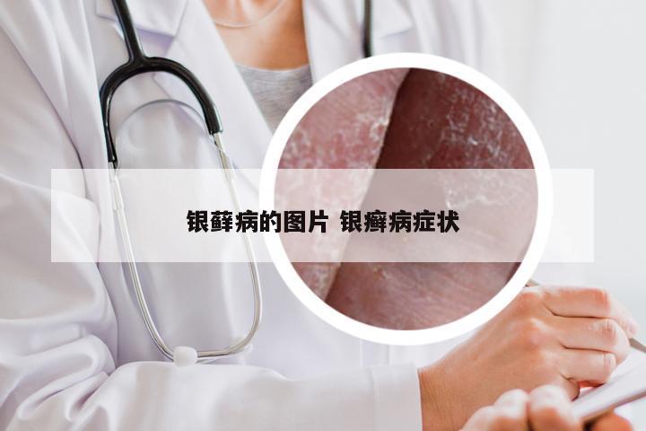 银藓病的图片 银癣病症状