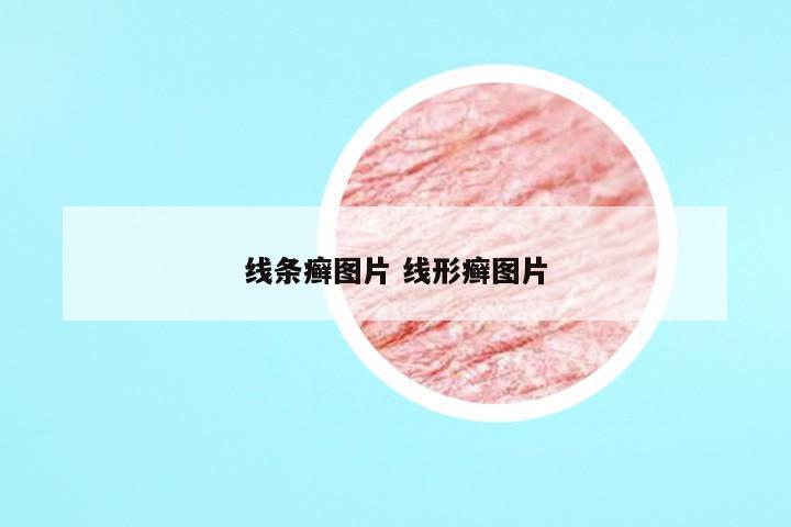 线条癣图片 线形癣图片