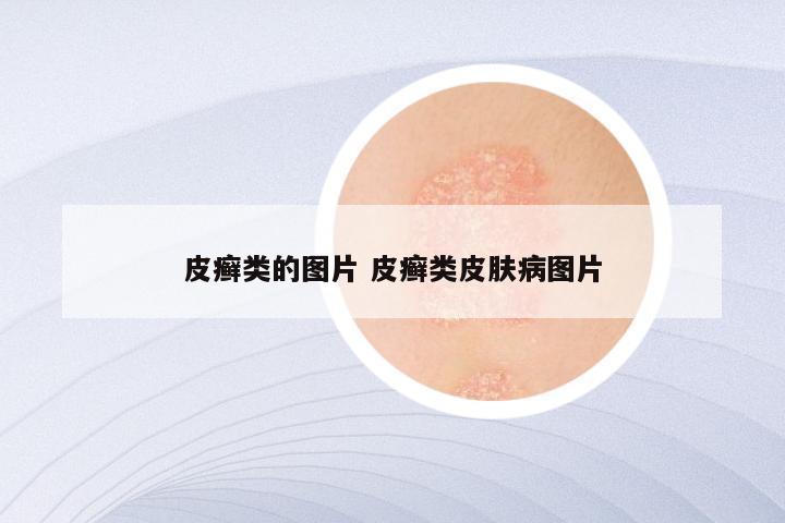 皮癣类的图片 皮癣类皮肤病图片