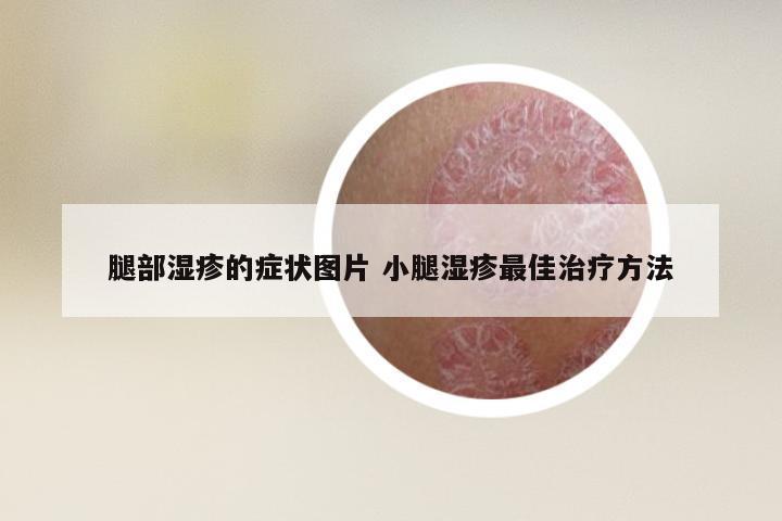 腿部湿疹的症状图片 小腿湿疹最佳治疗方法