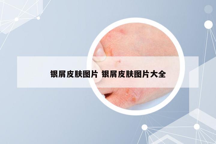 银屑皮肤图片 银屑皮肤图片大全