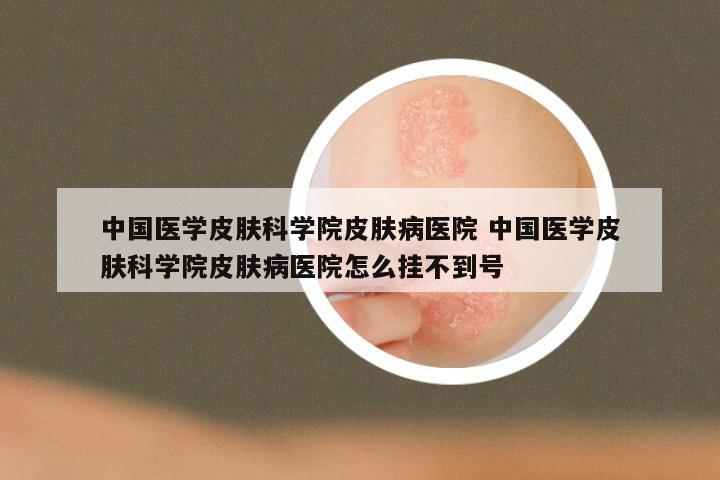 中国医学皮肤科学院皮肤病医院 中国医学皮肤科学院皮肤病医院怎么挂不到号